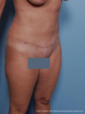 Philadelphia Abdominoplasty 9460 - After Image 2