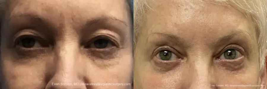 Blepharoplasty: Patient 3 - Before and After 1