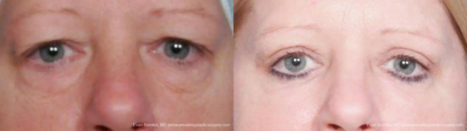 Philadelphia Blepharoplasty 9314 - Before and After 1