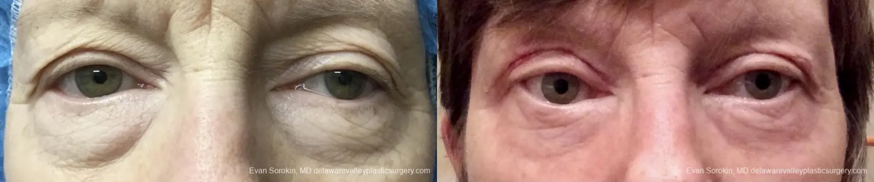 Blepharoplasty: Patient 2 - Before and After 1