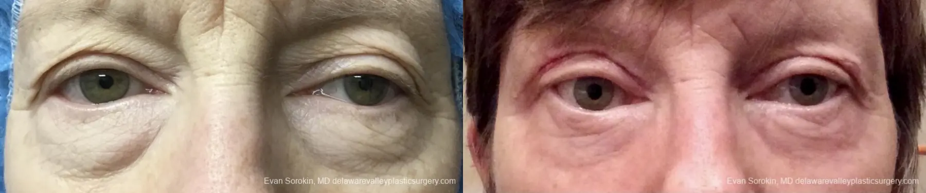 Blepharoplasty: Patient 2 - Before and After  