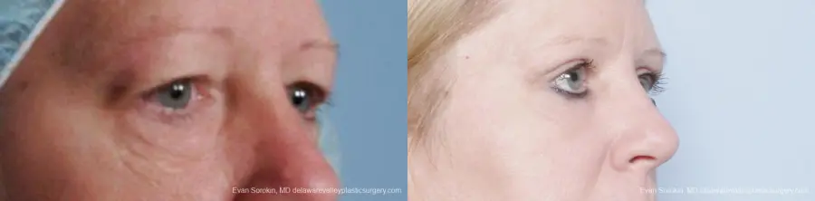 Philadelphia Blepharoplasty 9314 - Before and After 2