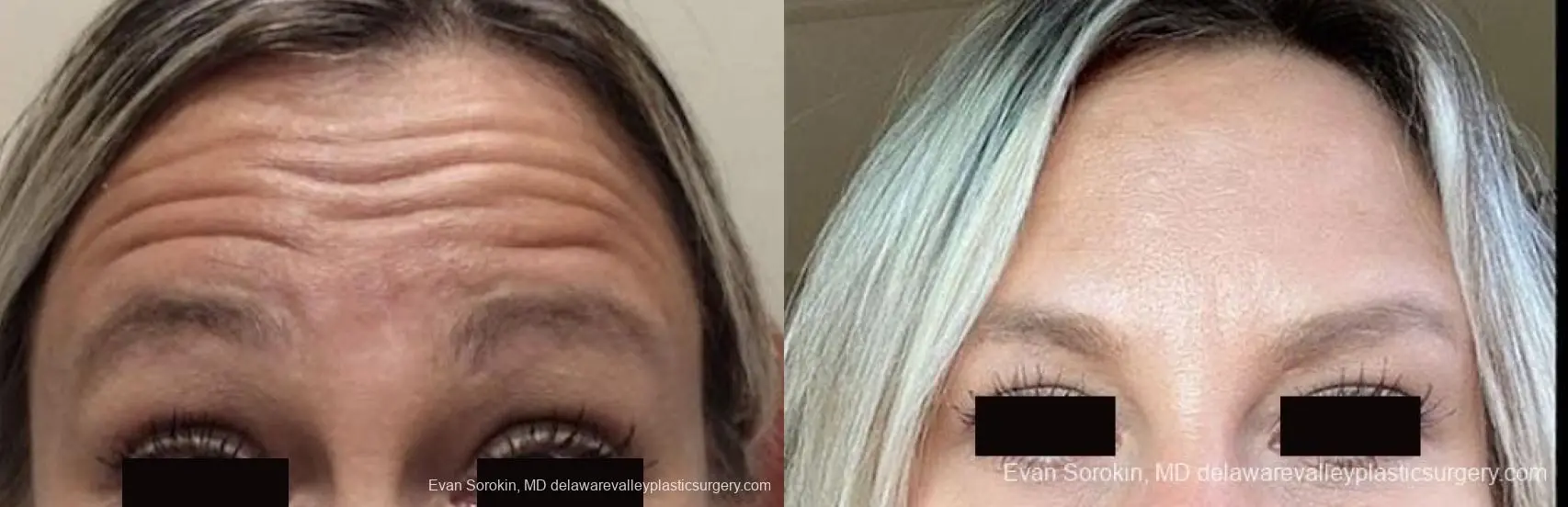 BOTOX® Cosmetic: Patient 3 - Before and After  