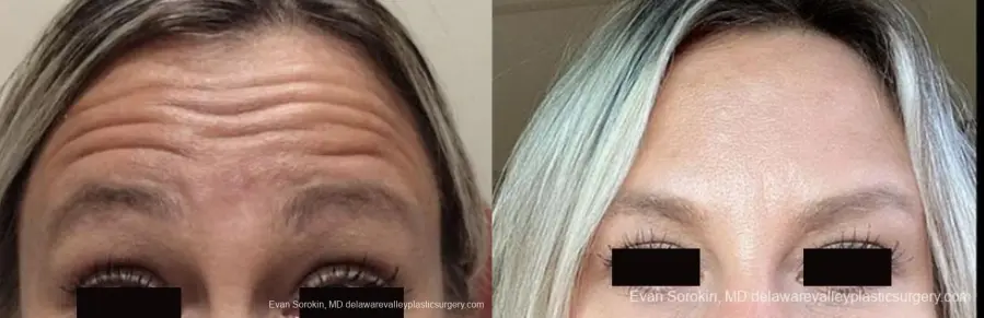 BOTOX® Cosmetic: Patient 4 - Before and After 1