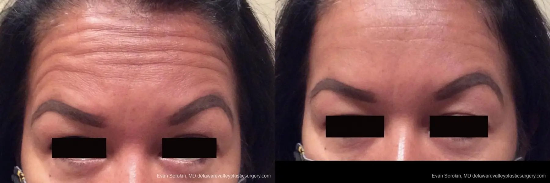 BOTOX® Cosmetic: Patient 2 - Before and After 1