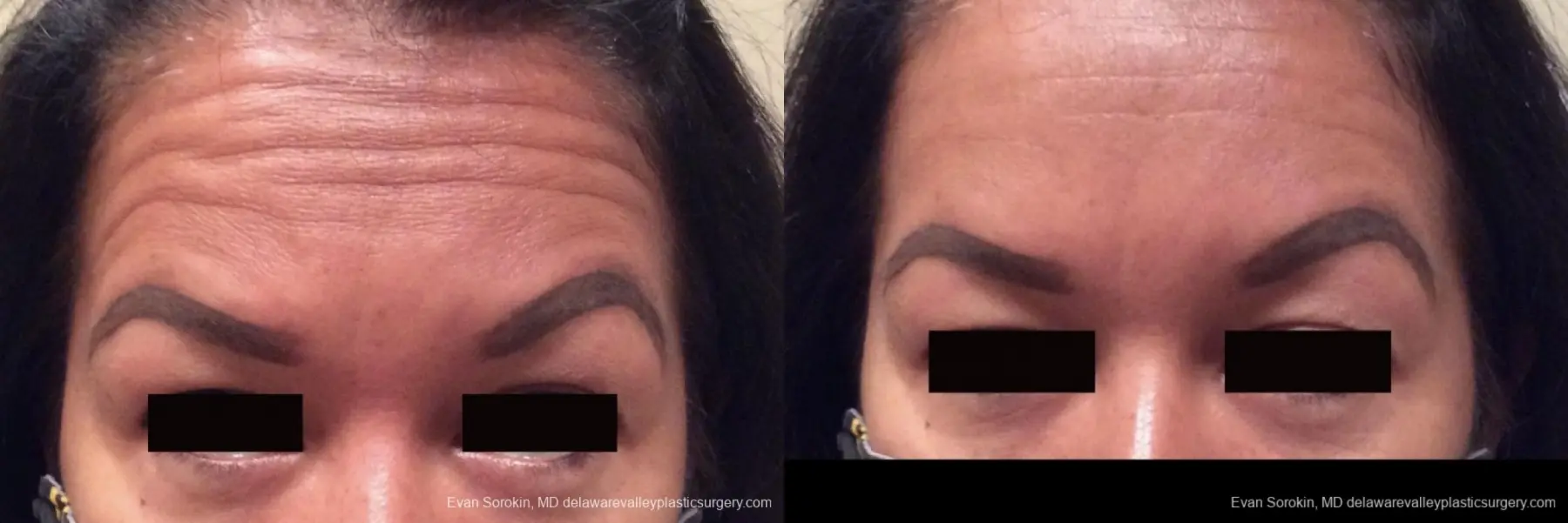 BOTOX® Cosmetic: Patient 1 - Before and After 1