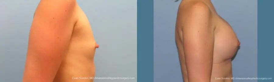 Philadelphia Breast Augmentation 10193 - Before and After 3