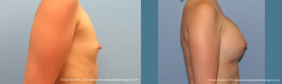 Philadelphia Breast Augmentation 10193 - Before and After 3