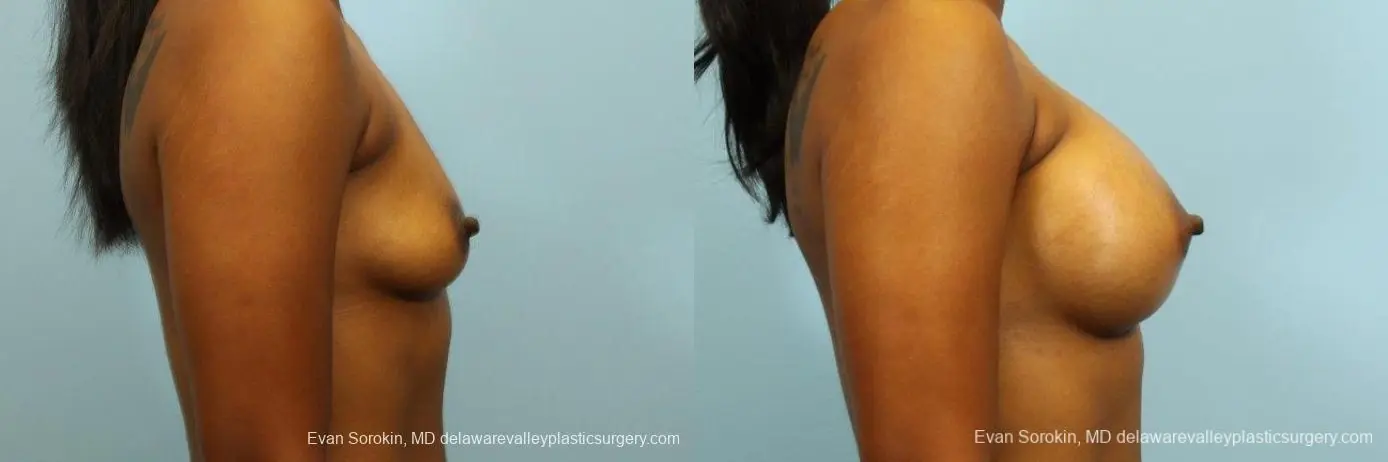 Philadelphia Breast Augmentation 8768 - Before and After 3