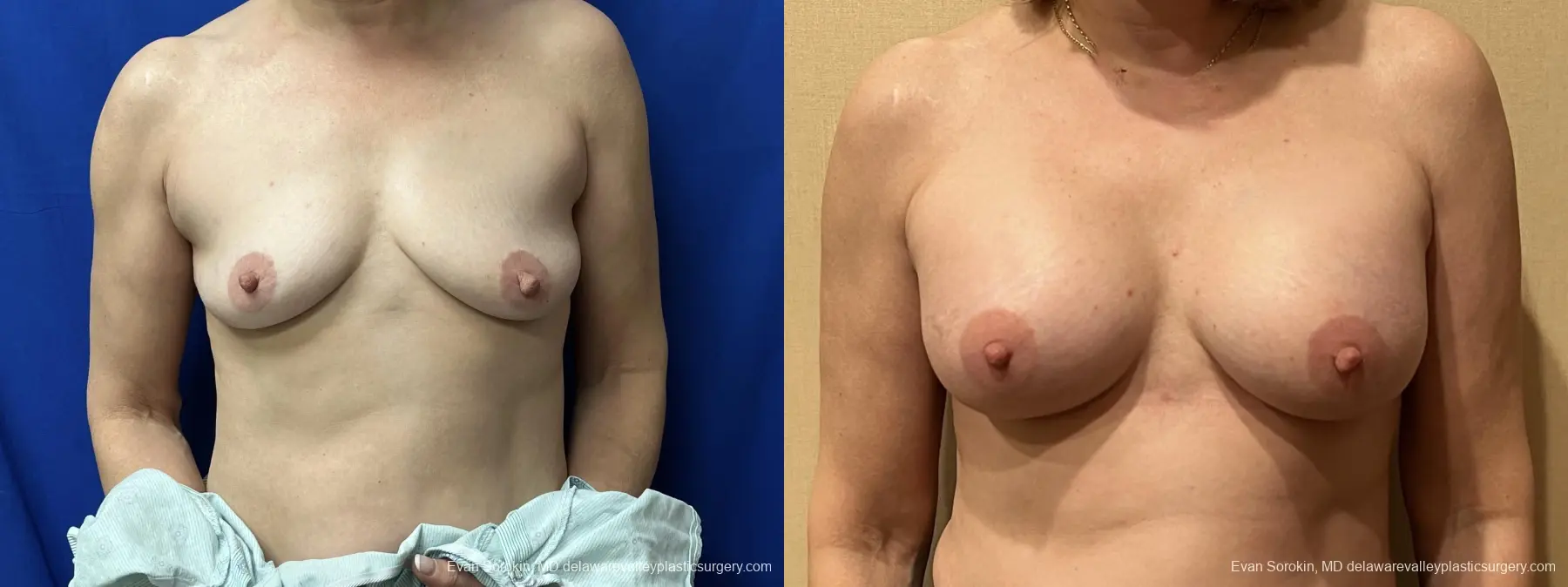 Breast Augmentation: Patient 217 - Before and After 1