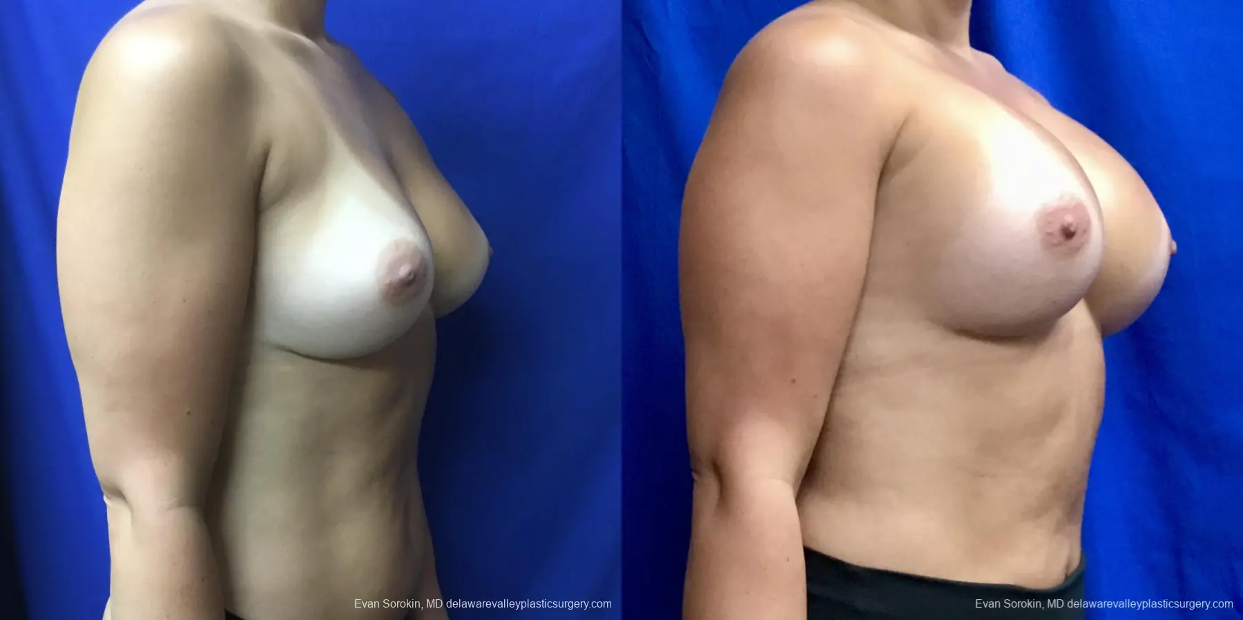 Breast Augmentation Revision: Patient 28 - Before and After 2