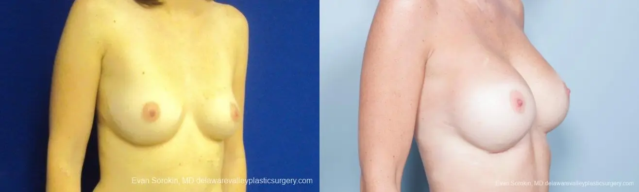 Philadelphia Breast Augmentation 8777 - Before and After 2