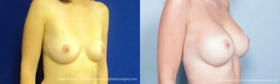 Philadelphia Breast Augmentation 8777 - Before and After 2