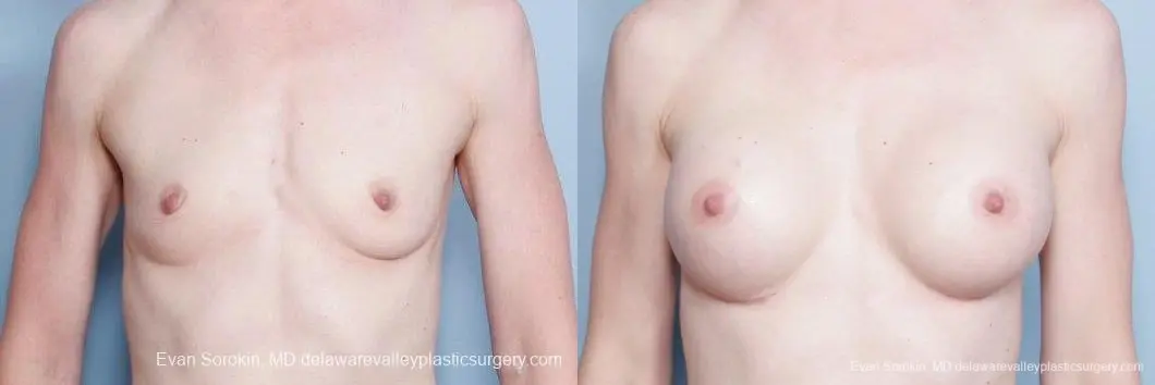 Philadelphia Breast Augmentation 9169 - Before and After 1