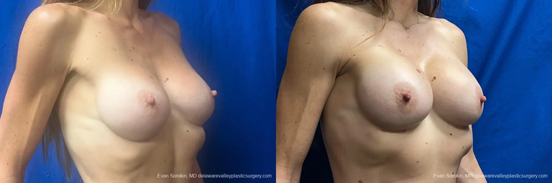 Breast Augmentation: Patient 279 - Before and After 2