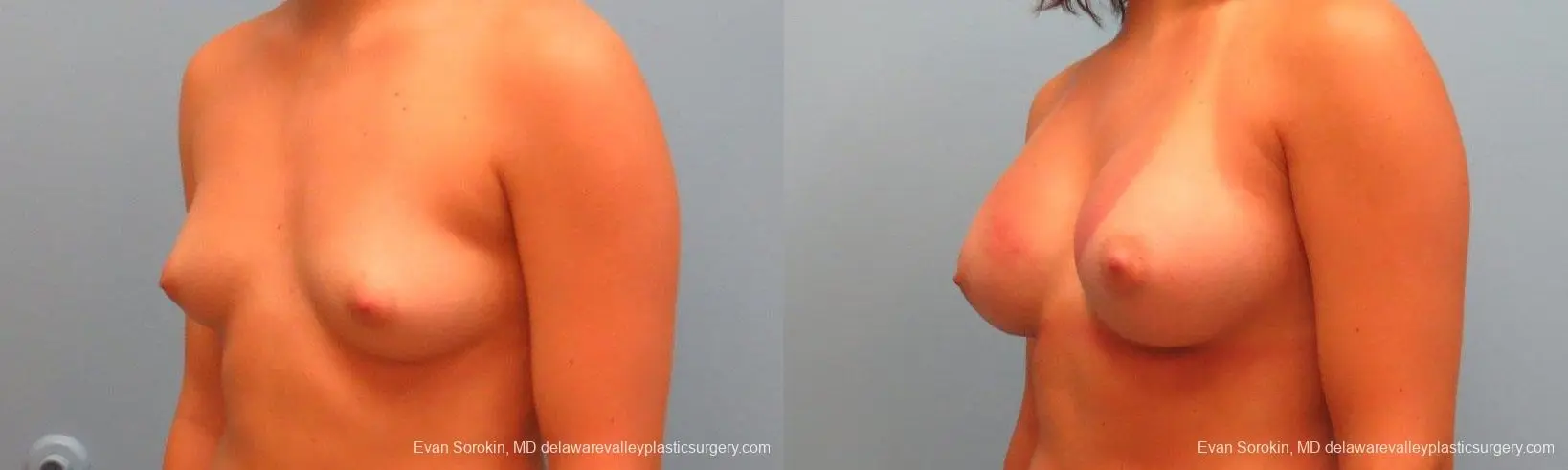 Philadelphia Breast Augmentation 9386 - Before and After 4