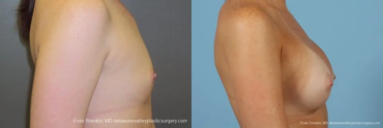 Philadelphia Breast Augmentation 8669 - Before and After 4