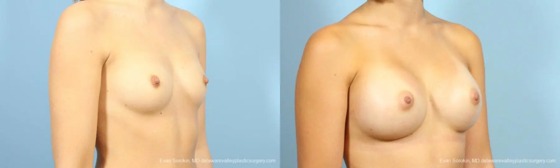 Philadelphia Breast Augmentation 8641 - Before and After 2