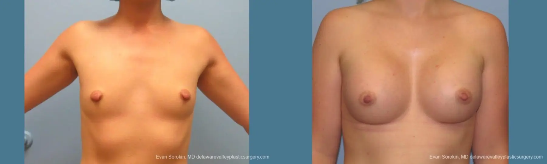 Philadelphia Breast Augmentation 10193 - Before and After 1