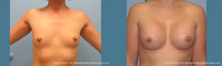 Philadelphia Breast Augmentation 10193 - Before and After 1