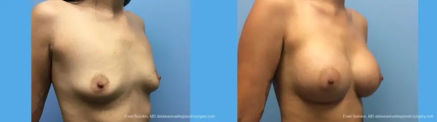 Breast Augmentation: Patient 137 - Before and After 4