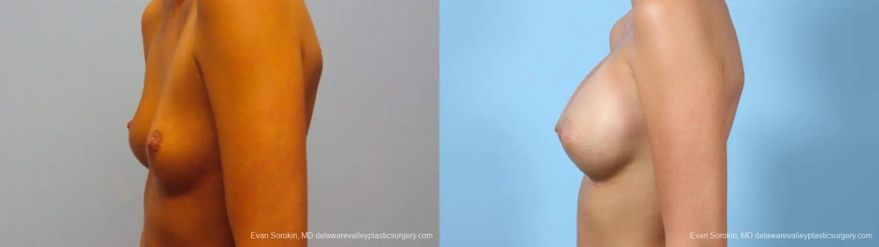 Philadelphia Breast Augmentation 9292 - Before and After 4