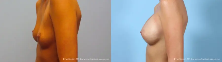 Philadelphia Breast Augmentation 9292 - Before and After 4