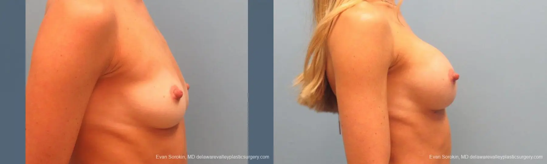 Philadelphia Breast Augmentation 9397 - Before and After 3
