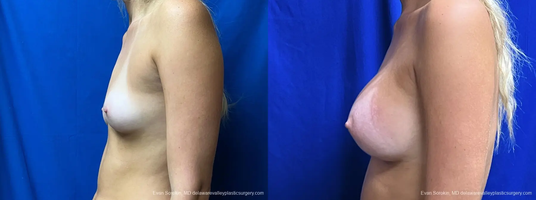 Breast Augmentation: Patient 254 - Before and After 5