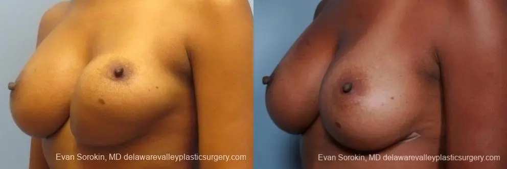 Philadelphia Breast Augmentation 8653 - Before and After 3