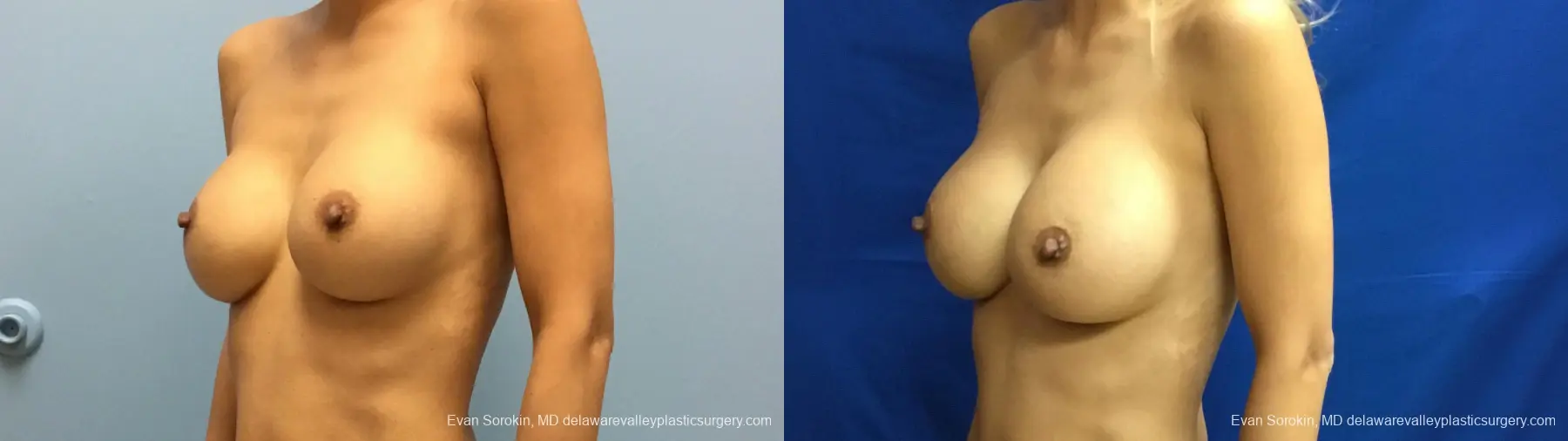 Philadelphia Breast Augmentation 13178 - Before and After 4