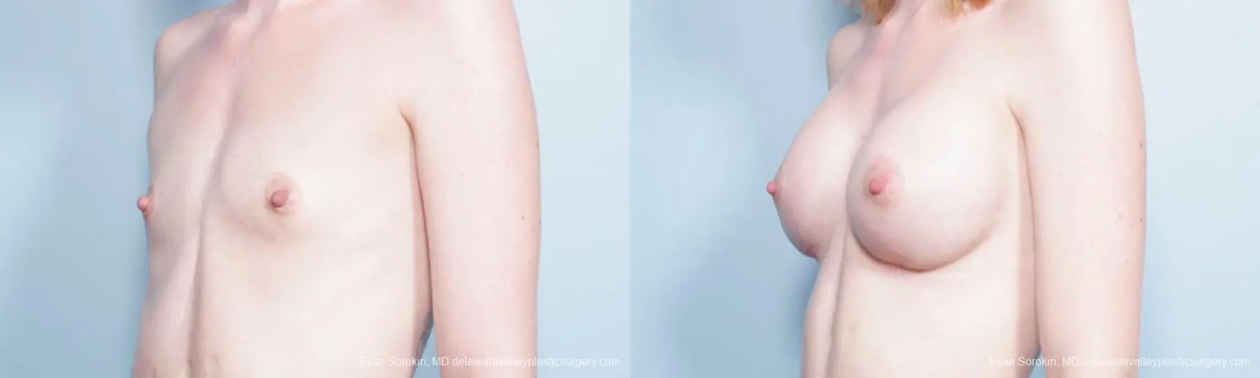 Philadelphia Breast Augmentation 9300 - Before and After 4