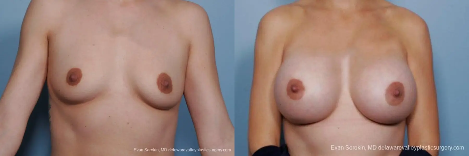 Philadelphia Breast Augmentation 9385 - Before and After 1