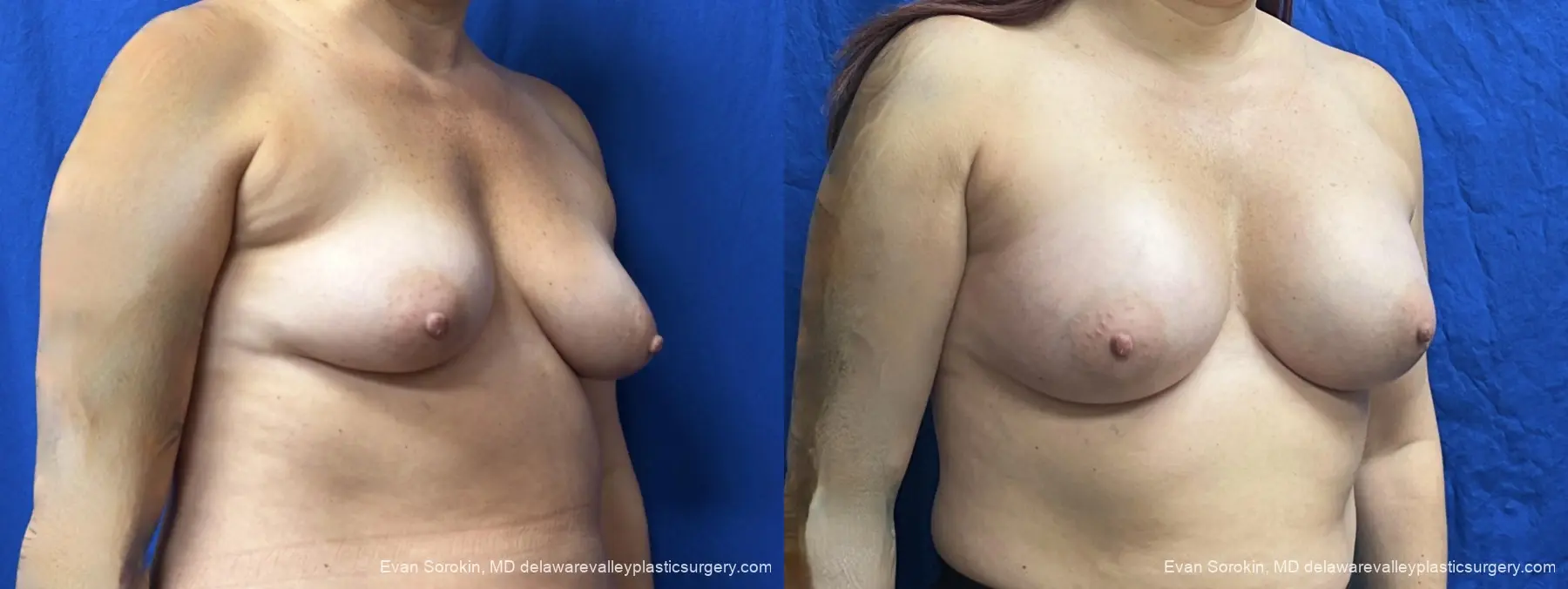 Breast Augmentation: Patient 314 - Before and After 2