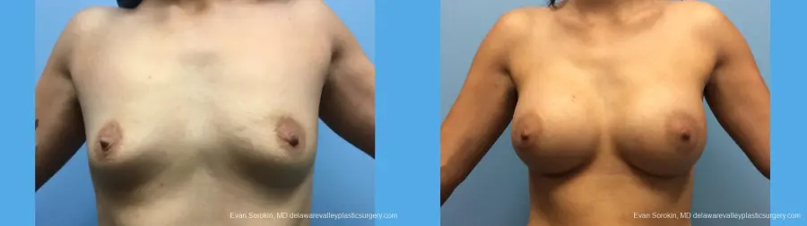 Breast Augmentation: Patient 137 - Before and After 1