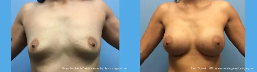 Breast Augmentation: Patient 137 - Before and After 1