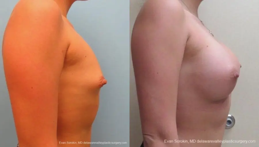 Philadelphia Breast Augmentation 8826 - Before and After 4