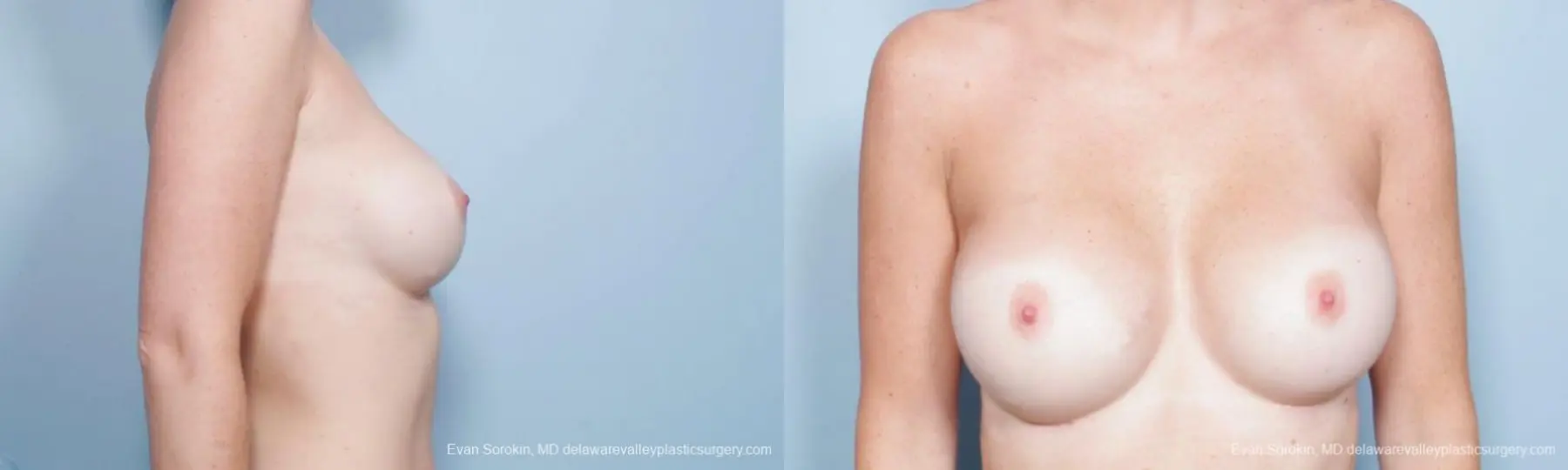 Philadelphia Breast Augmentation 9402 - Before and After 3