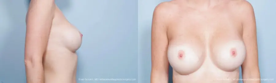 Philadelphia Breast Augmentation 9402 - Before and After 3