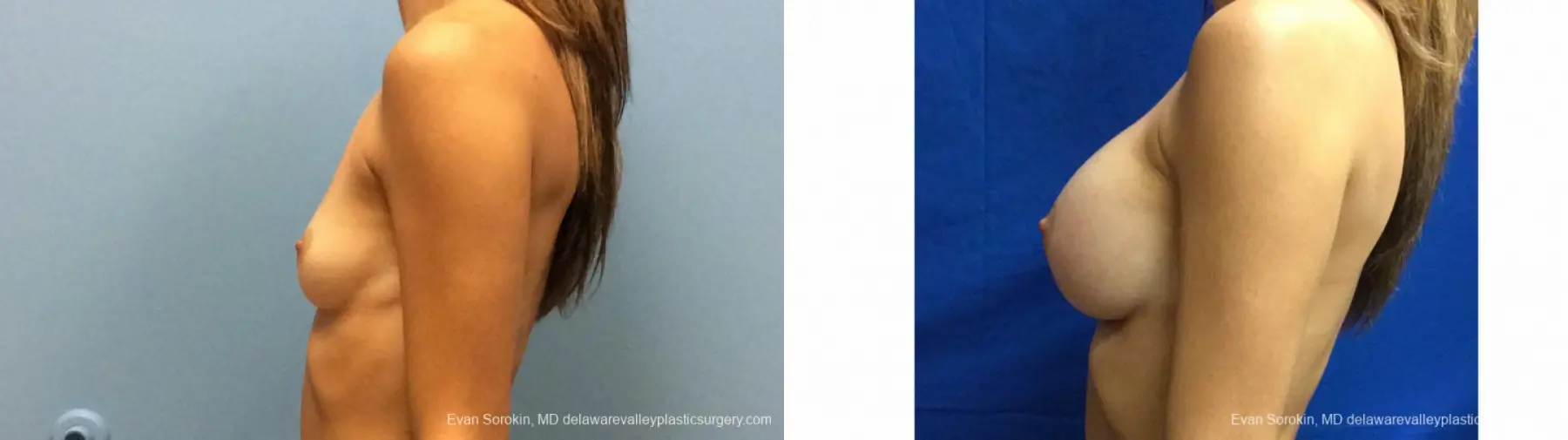 Philadelphia Breast Augmentation 13180 - Before and After 5