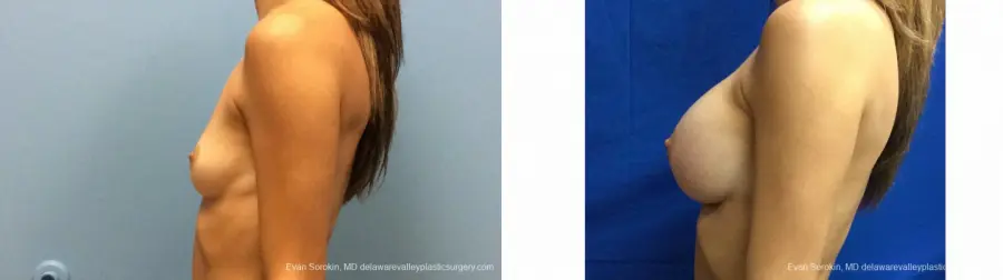 Philadelphia Breast Augmentation 13180 - Before and After 5