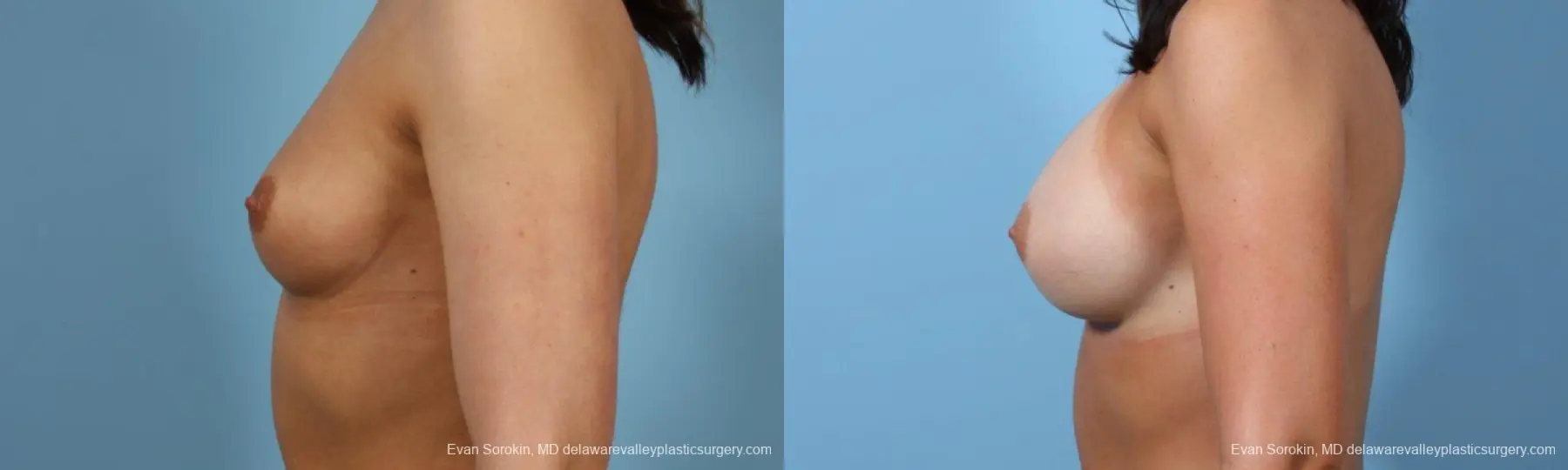 Philadelphia Breast Augmentation 8643 - Before and After 5