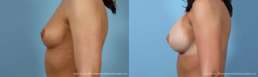 Philadelphia Breast Augmentation 8643 - Before and After 5