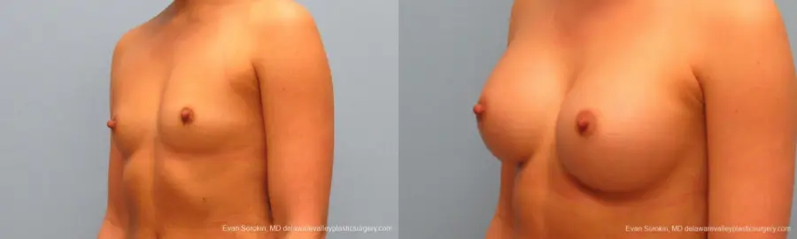 Philadelphia Breast Augmentation 9410 - Before and After 4