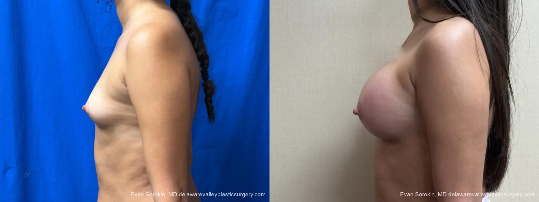 Breast Augmentation: Patient 283 - Before and After 5