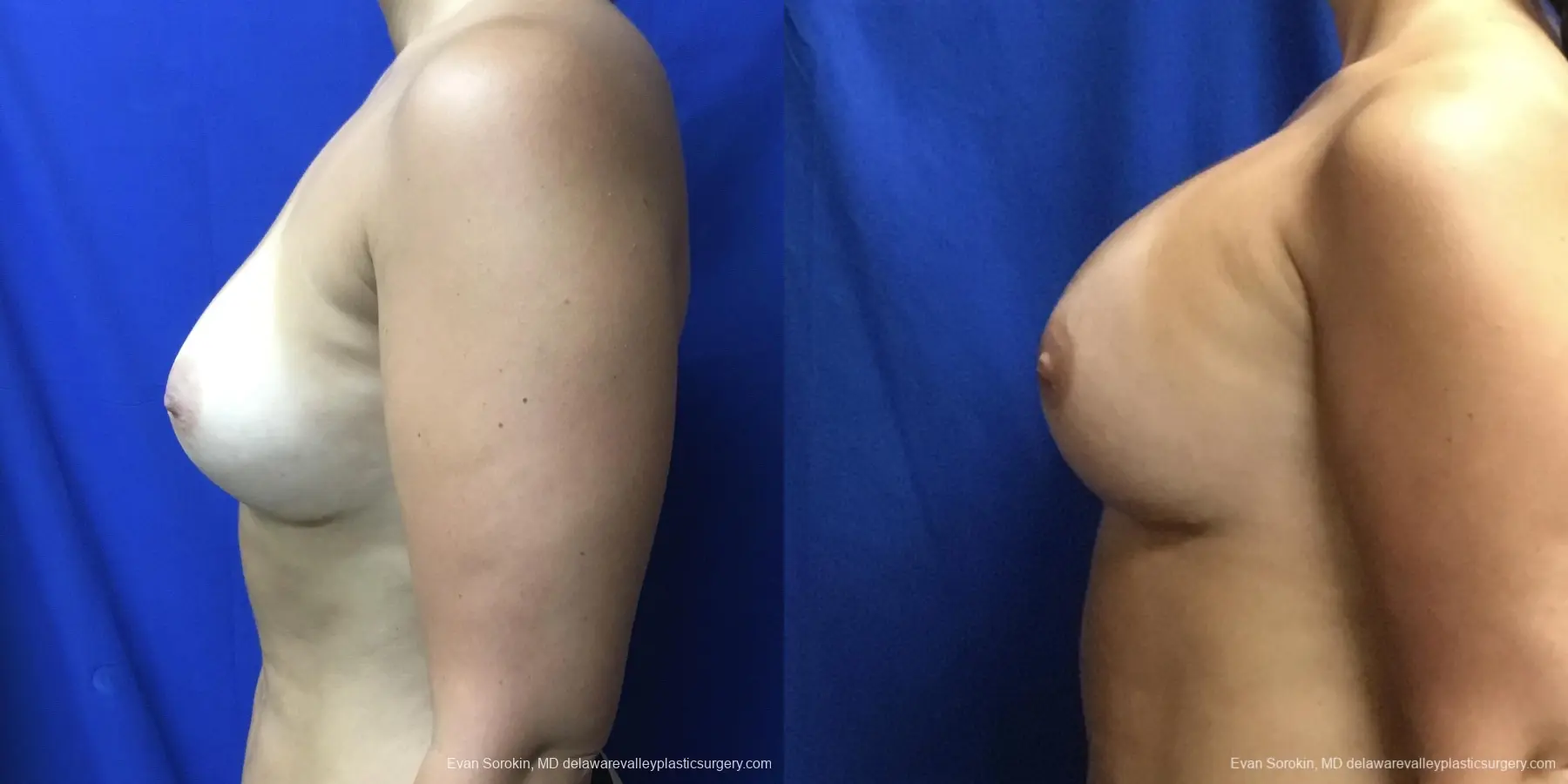 Breast Augmentation Revision: Patient 28 - Before and After 5
