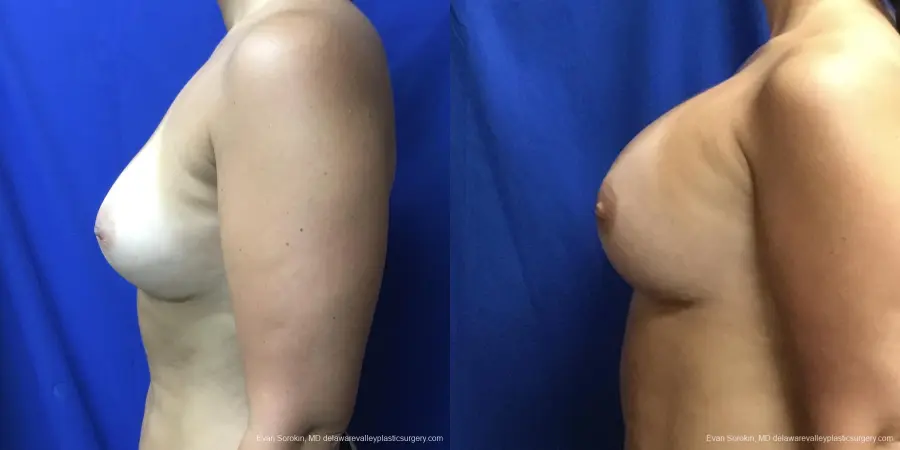 Breast Augmentation Revision: Patient 28 - Before and After 5