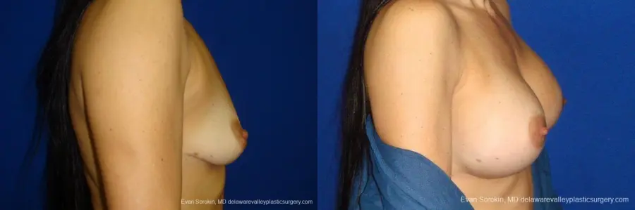 Philadelphia Breast Augmentation 9413 - Before and After 3