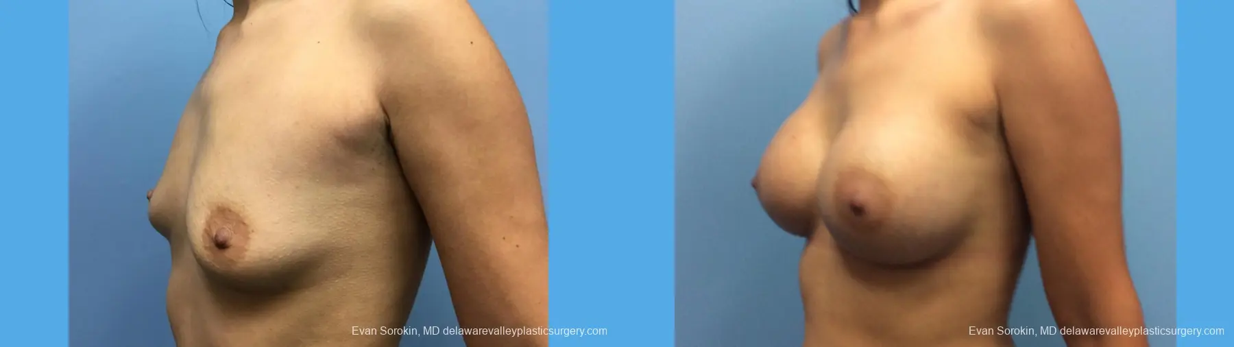 Breast Augmentation: Patient 155 - Before and After 2