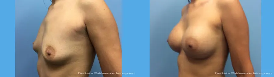 Breast Augmentation: Patient 137 - Before and After 2